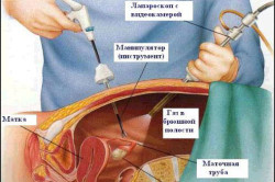 Схема проведения холецистэктомии