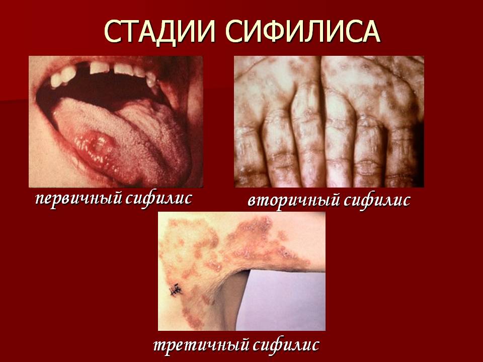 Стадии сифилиса